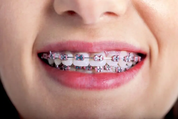 Braces Cost with Insurance