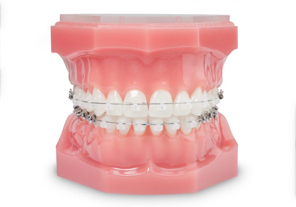 How Long Does it Take to Get Ceramic Braces Put On?