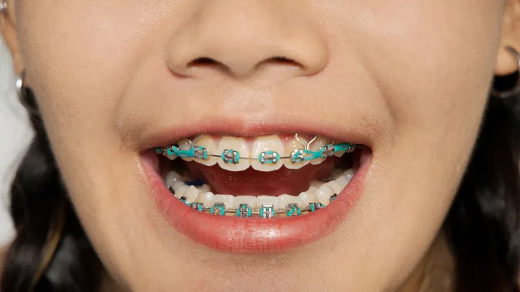 Do I Have to Have Insurance to Have Orthodontic Treatment?